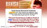 Banish Tonsil Stones